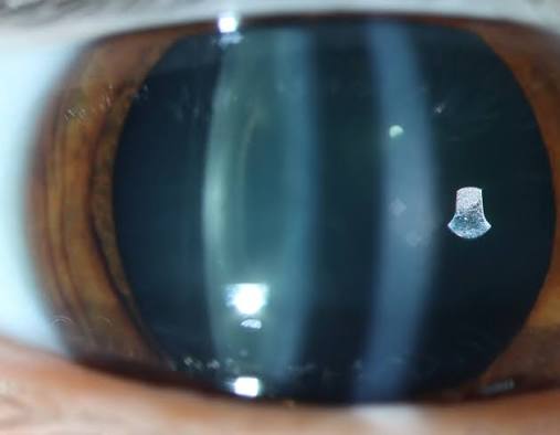 Clinical eye photograph illustrating Electric Cataract