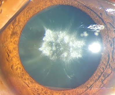 Clinical eye photograph illustrating Electric Cataract