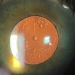 Clinical eye photograph illustrating Elschnig Pearls Posterior Capsule Opacification