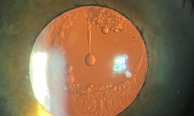 Elschnig Pearls and Posterior Capsule Opacification: Why the Vision Clouds Again After Cataract Surgery