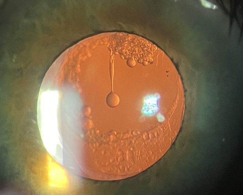 Elschnig Pearls and Posterior Capsule Opacification: Why the Vision Clouds Again After Cataract Surgery