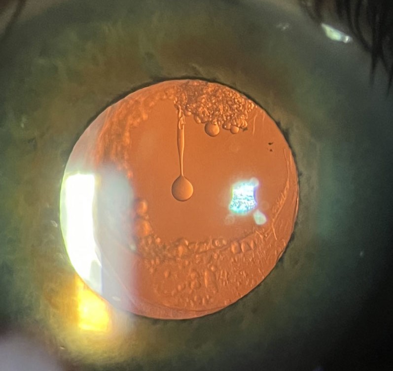 Clinical eye photograph illustrating Elschnig Pearls Posterior Capsule Opacification