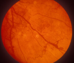 Clinical eye photograph illustrating Emerging Treatments Diabetic Retinopathy