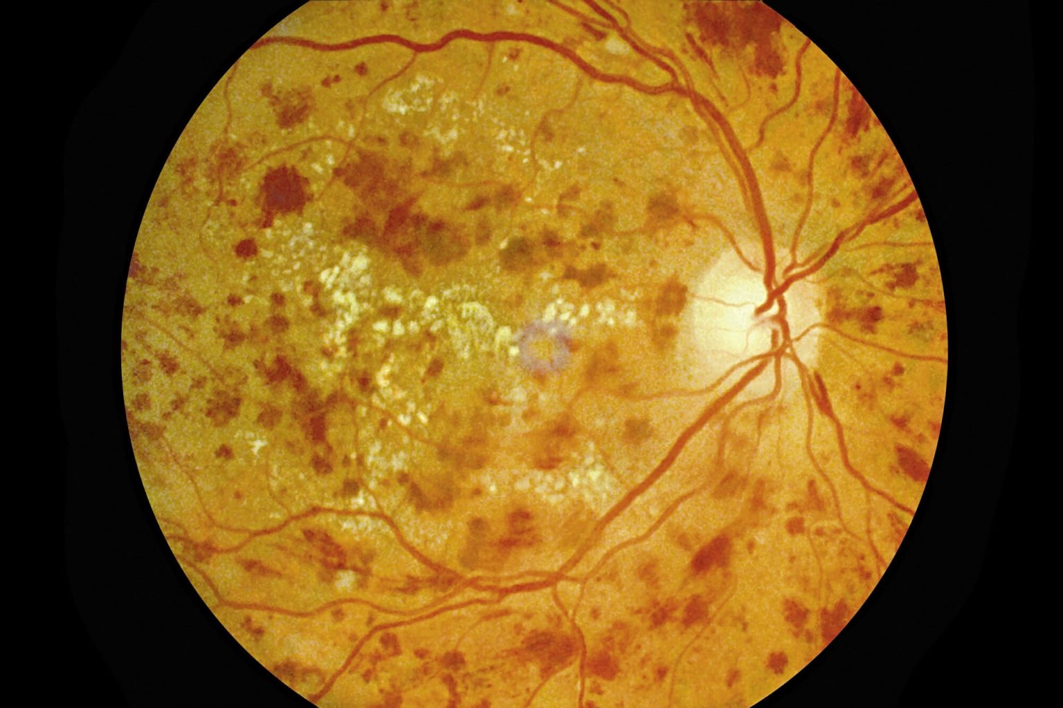 Clinical eye photograph illustrating Emerging Treatments Diabetic Retinopathy
