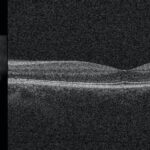 Clinical eye photograph illustrating En Face Oct Plan View Layers