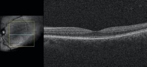Clinical eye photograph illustrating En Face Oct Plan View Layers