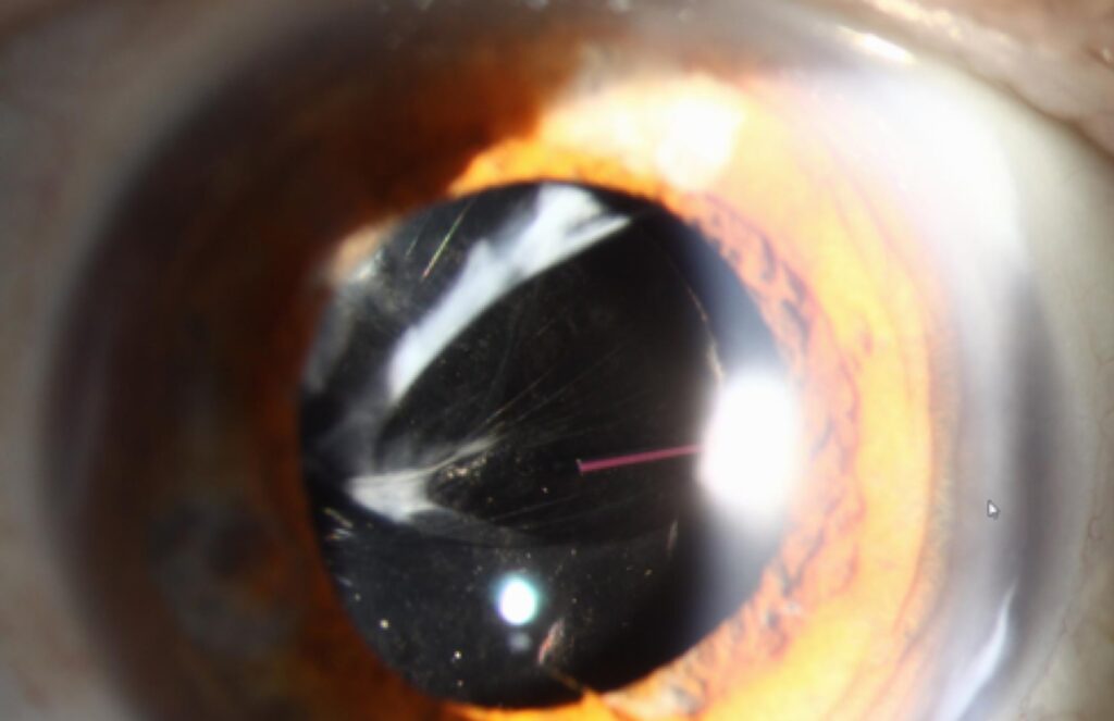 Clinical eye photograph illustrating Enhanced Monofocal Iol