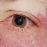 Clinical eye photograph illustrating Episcleral Hemangioma