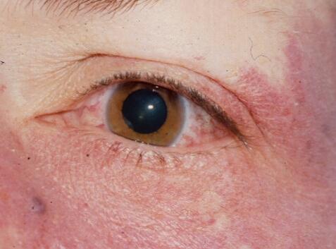 Episcleral Hemangioma: A Vascular Mass That Can Point to Sturge-Weber Syndrome