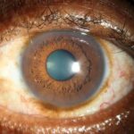Clinical eye photograph illustrating Episcleral Nevus Pigmented Lesion
