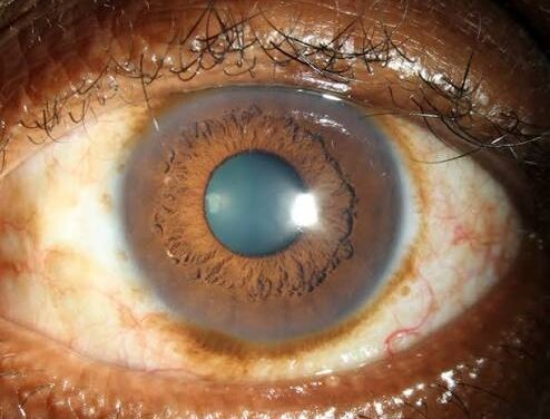 Episcleral Nevus: A Pigmented Lesion Beyond the Iris Worth Its Own Watch List