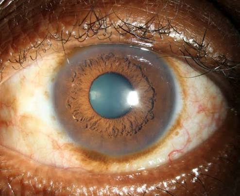 Episcleral Nevus: A Pigmented Lesion Beyond the Iris Worth Its Own Watch List