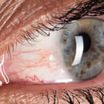 Clinical eye photograph illustrating Episcleritis Causes Symptoms Treatment