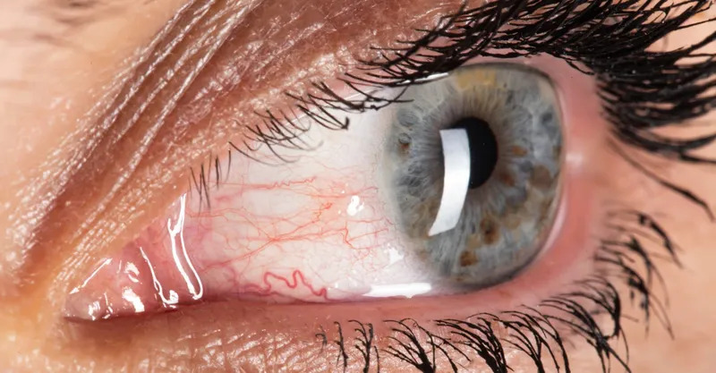 Clinical eye photograph illustrating Episcleritis Causes Symptoms Treatment