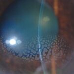 Clinical eye photograph illustrating Epithelial Ingrowth After Lasik