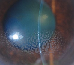 Epithelial Ingrowth After LASIK: When Cells Grow Where They Don’t Belong