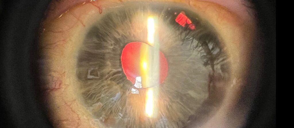 Clinical eye photograph illustrating Essential Iris Atrophy Ice Spectrum