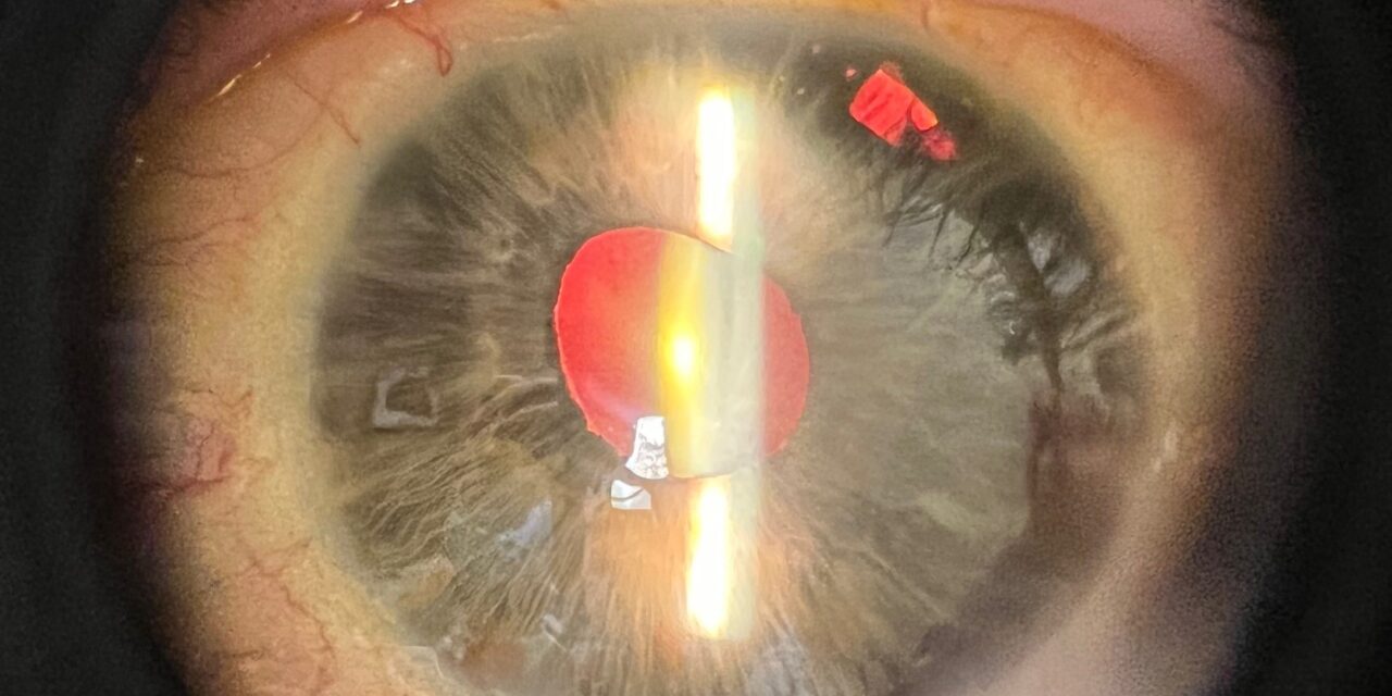 Essential Iris Atrophy: The Progressive Face of the ICE Syndrome Spectrum