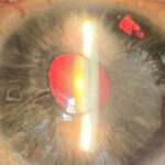Clinical eye photograph illustrating Essential Iris Atrophy Ice Spectrum