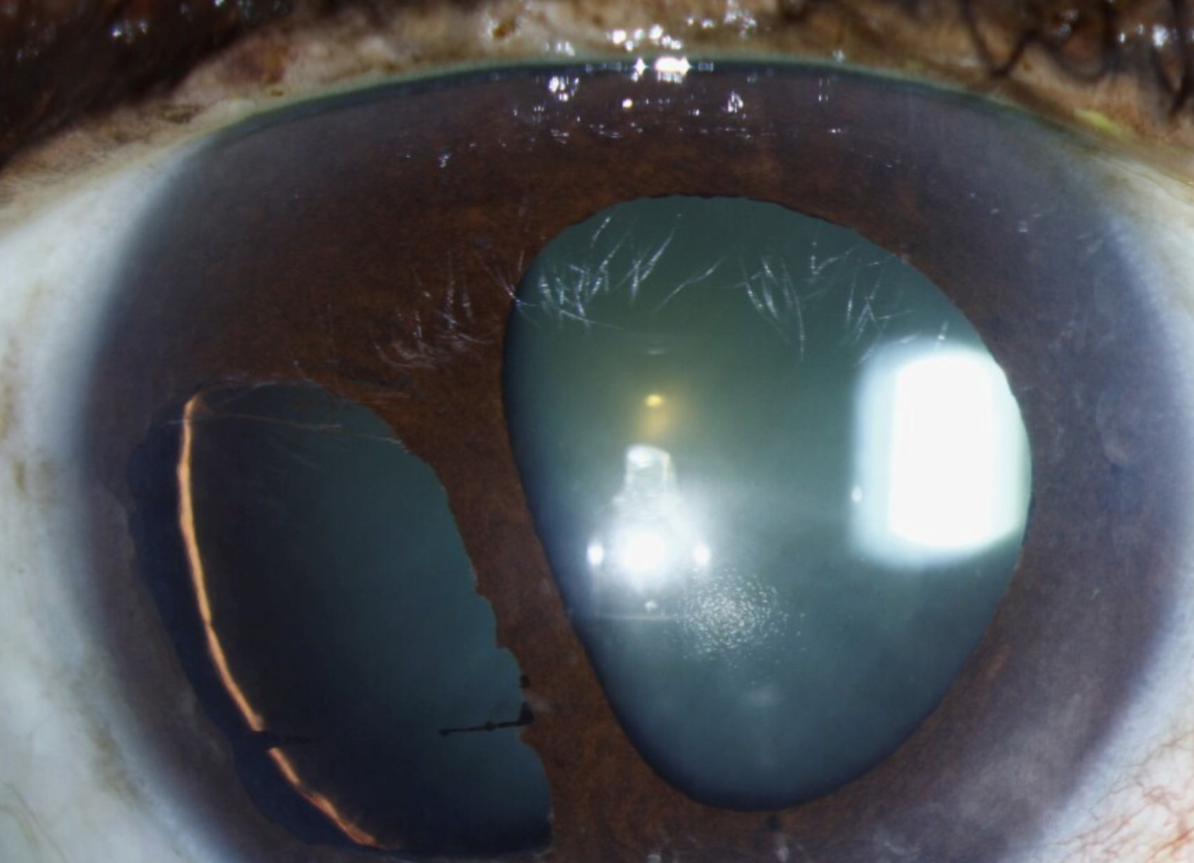 Clinical eye photograph illustrating Essential Iris Atrophy Ice Spectrum