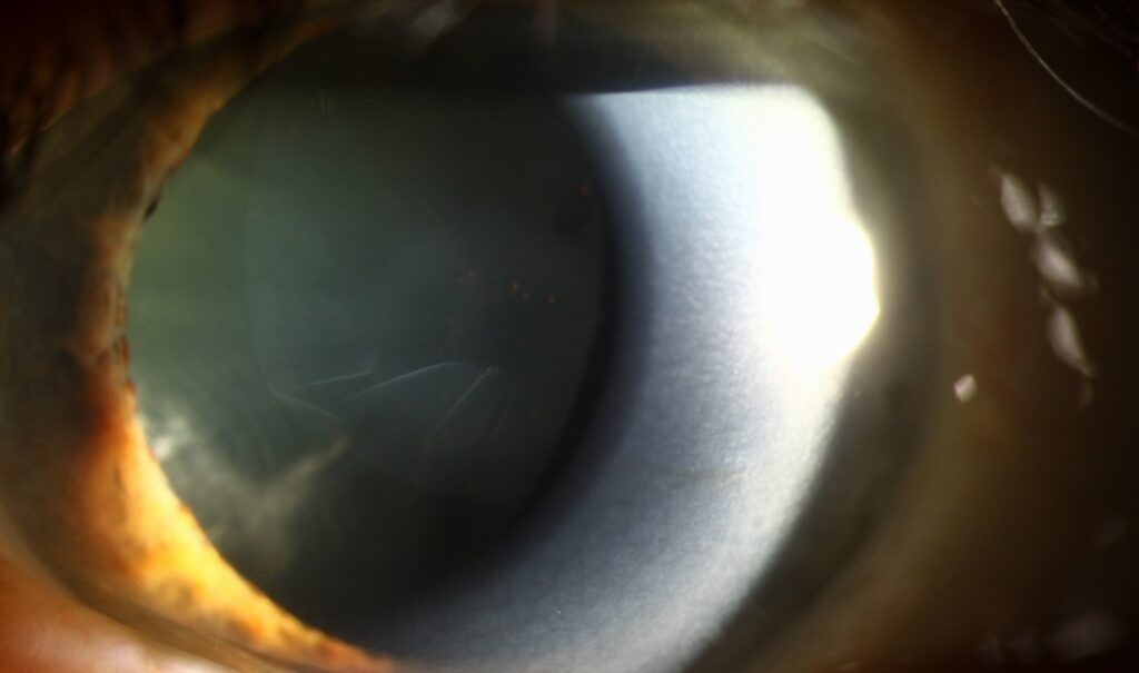 Clinical eye photograph illustrating Exfoliation Glaucoma