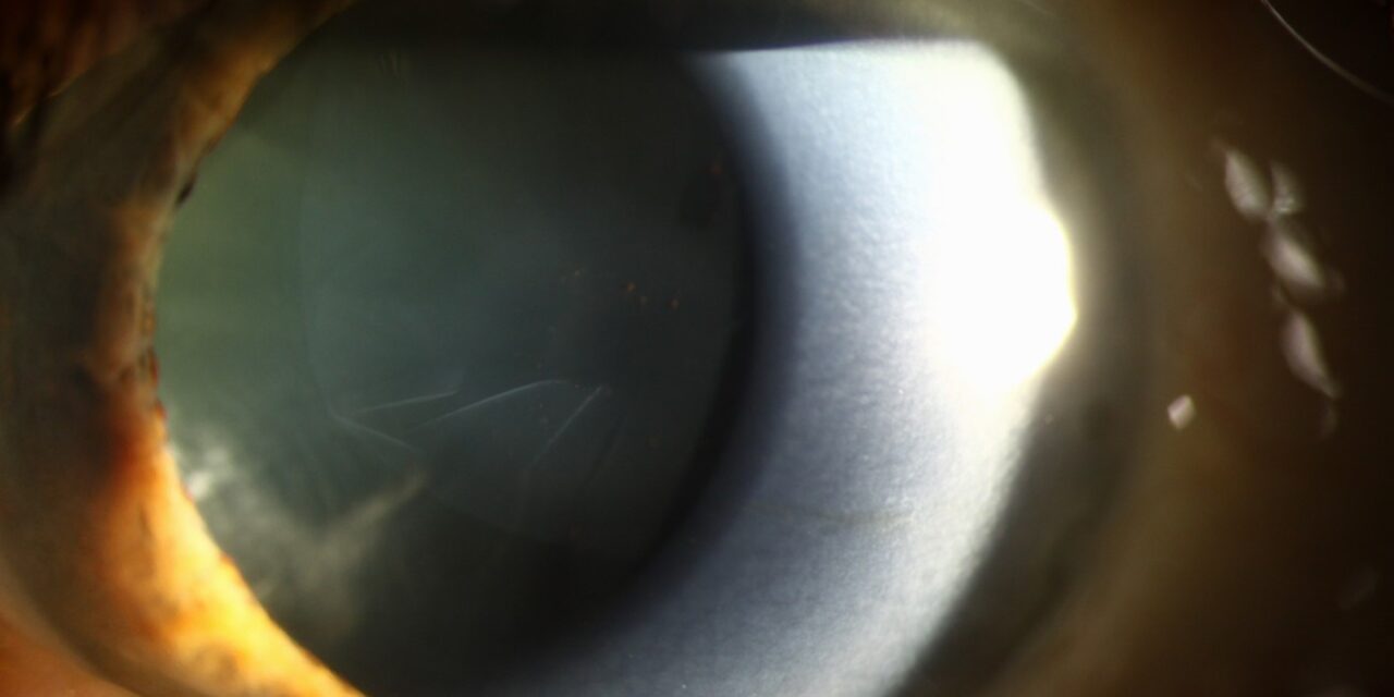Exfoliation Glaucoma: The More Aggressive Complication of a Common Syndrome