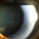 Clinical eye photograph illustrating Exfoliation Glaucoma