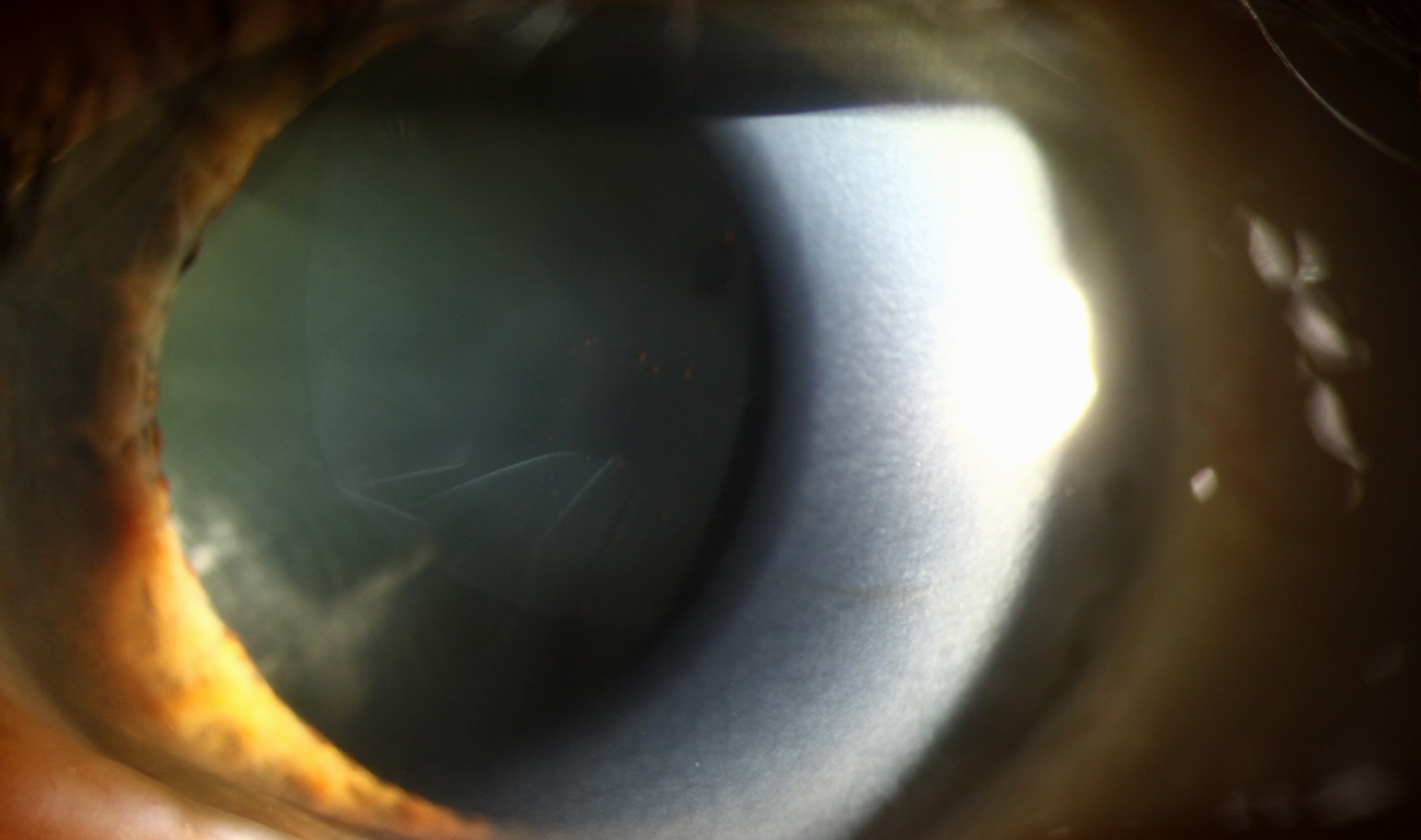 Clinical eye photograph illustrating Exfoliation Glaucoma