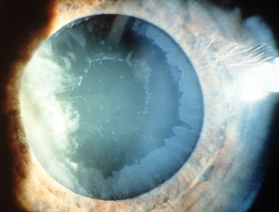 Clinical eye photograph illustrating Exfoliation Glaucoma