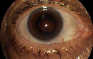 Clinical eye photograph illustrating Extended Depth Focus Iol