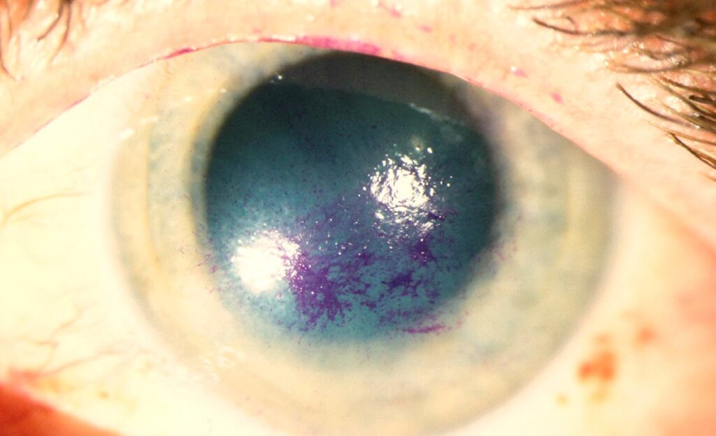Clinical image illustrating Eye Emergencies