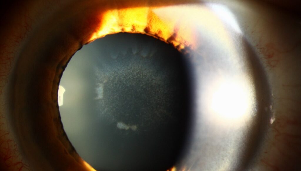 Clinical image illustrating Eye Rubbing