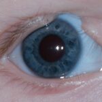 Clinical eye photograph illustrating Eyelid Coloboma Repair Technique