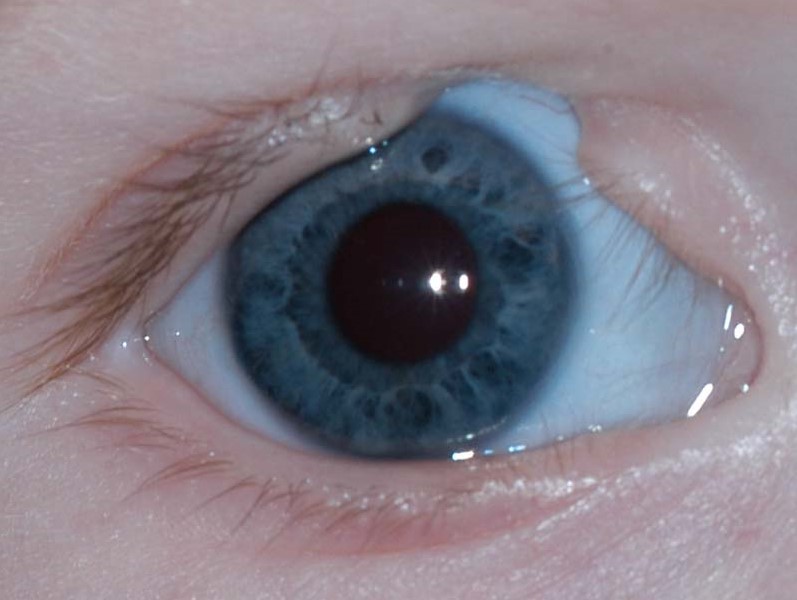 Eyelid Coloboma: Repairing a Congenital Full-Thickness Defect Before It Threatens the Cornea