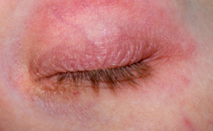 Clinical eye photograph illustrating Eyelid Contact Dermatitis
