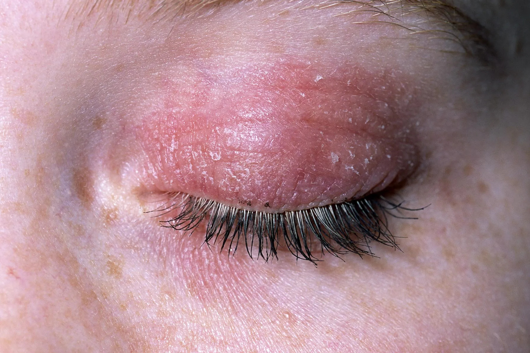 Clinical eye photograph illustrating Eyelid Contact Dermatitis