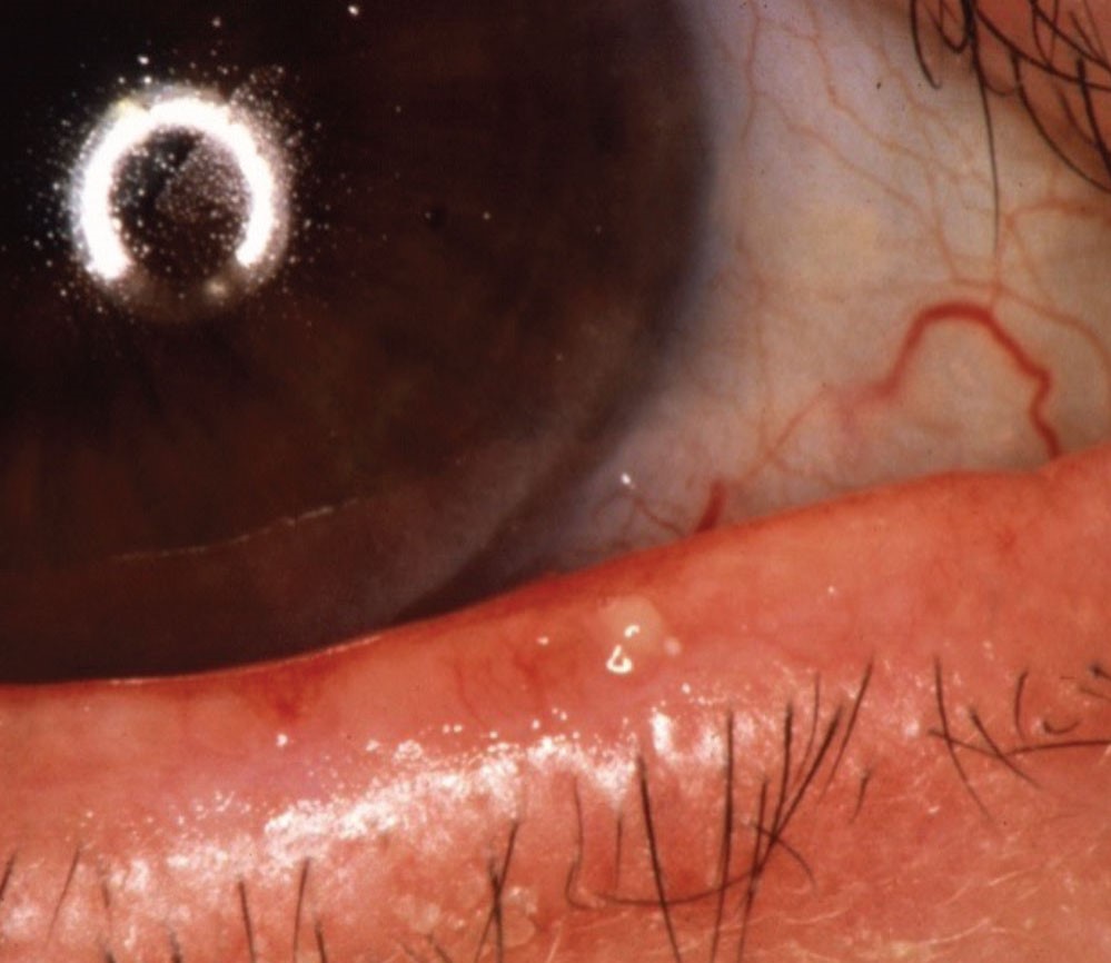 Clinical image illustrating Eyelid Hygiene (figure 1)