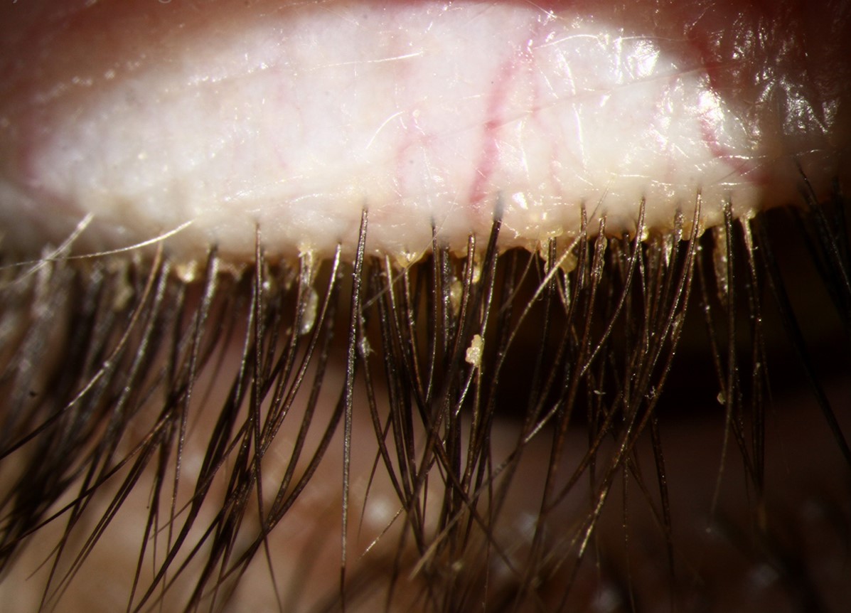Clinical image illustrating Eyelid Hygiene (figure 2)