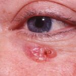 Clinical image illustrating Eyelid Lumps (figure 1)