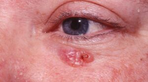 Clinical image illustrating Eyelid Lumps (figure 1)