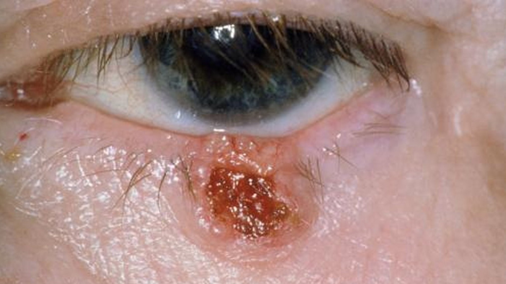 Clinical image illustrating Eyelid Lumps (figure 2)