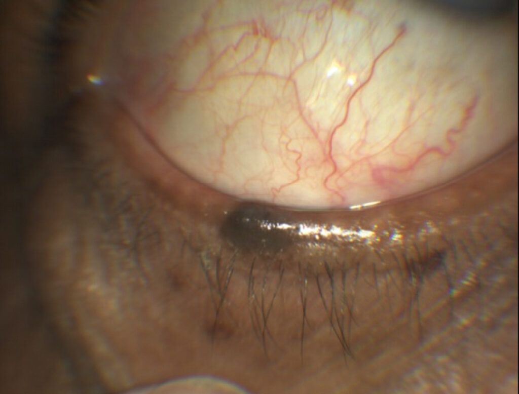 Clinical eye photograph illustrating Eyelid Nevus