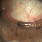 Clinical eye photograph illustrating Eyelid Nevus