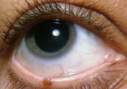 Clinical eye photograph illustrating Eyelid Nevus
