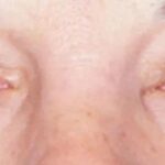 Clinical eye photograph illustrating Eyelid Retraction Causes