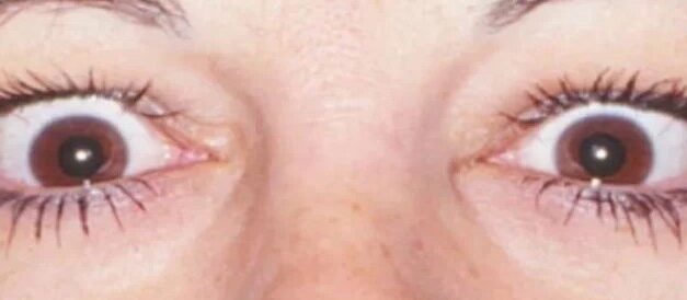 Eyelid Retraction: A Causes-Based Approach Beyond Thyroid Eye Disease