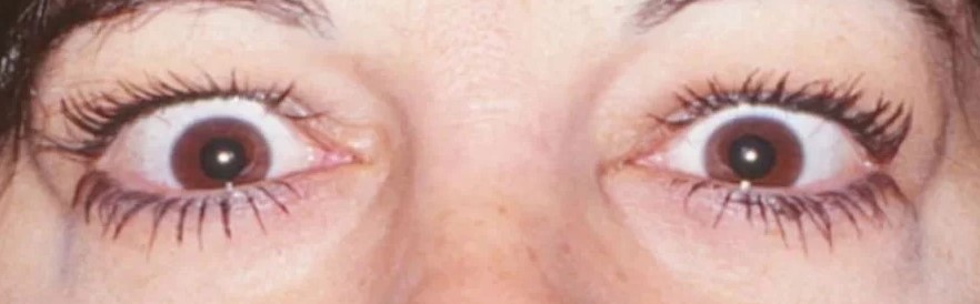 Clinical eye photograph illustrating Eyelid Retraction Causes