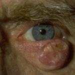 Clinical eye photograph illustrating Eyelid Squamous Cell Carcinoma