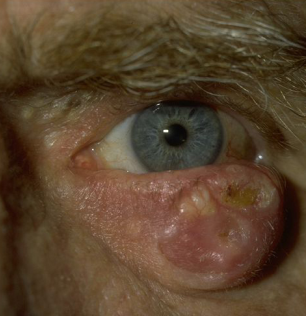 Eyelid Squamous Cell Carcinoma: The Less Common Eyelid Cancer With the Greater Risk of Spread