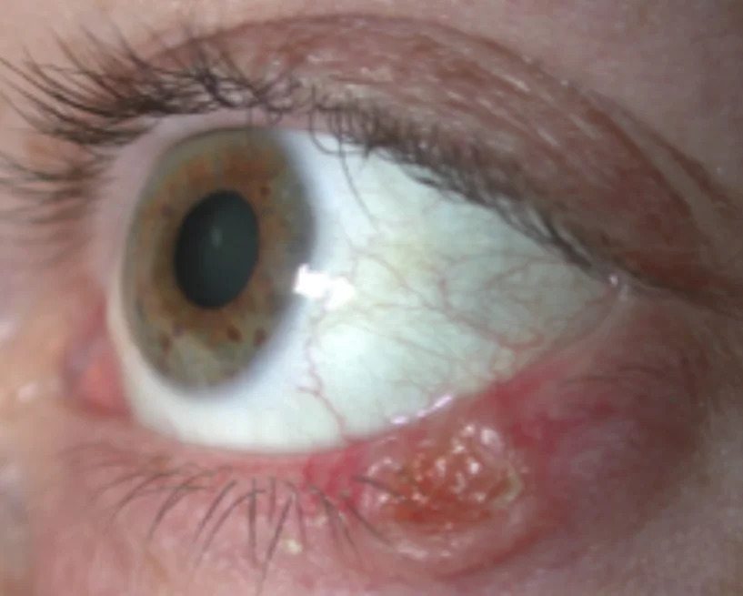 Clinical eye photograph illustrating Eyelid Squamous Cell Carcinoma
